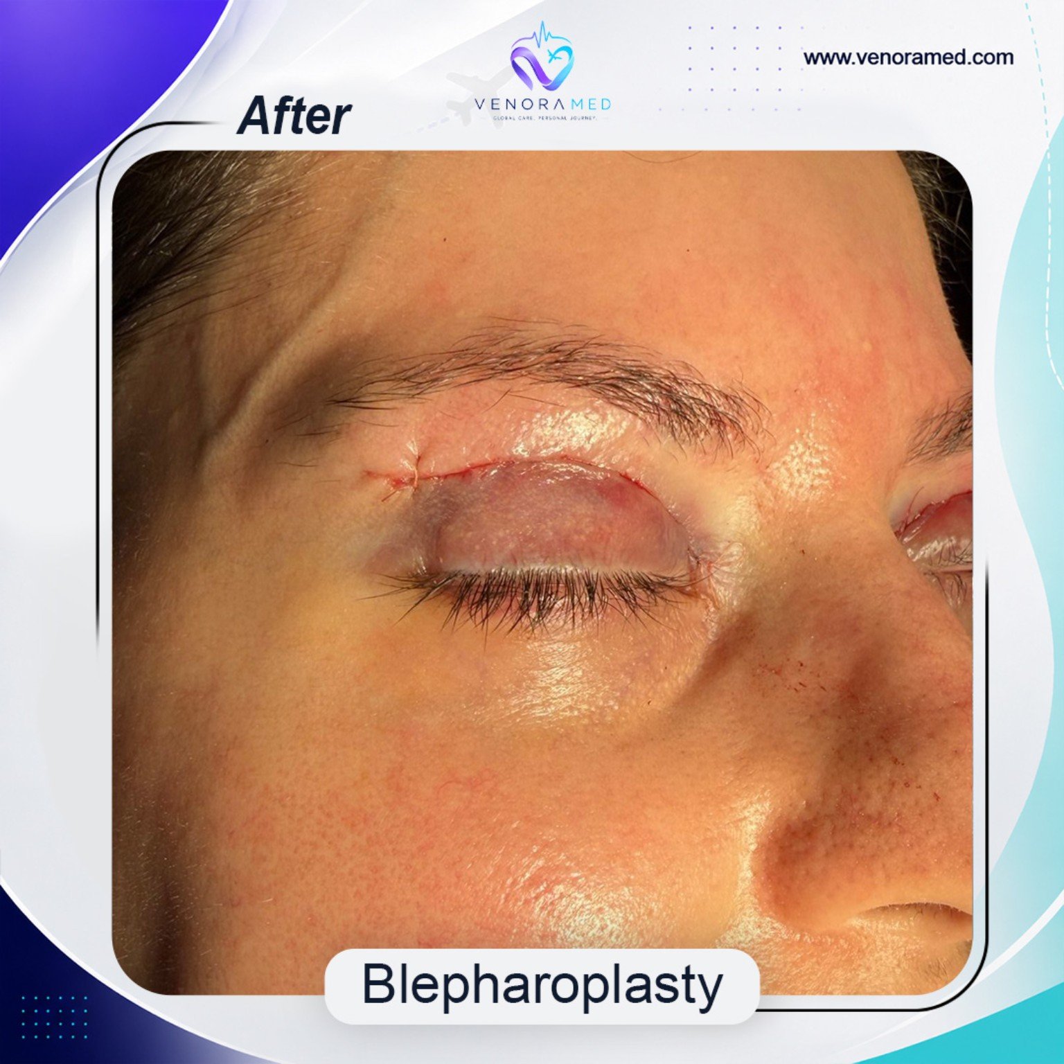 Blefaroplasti
