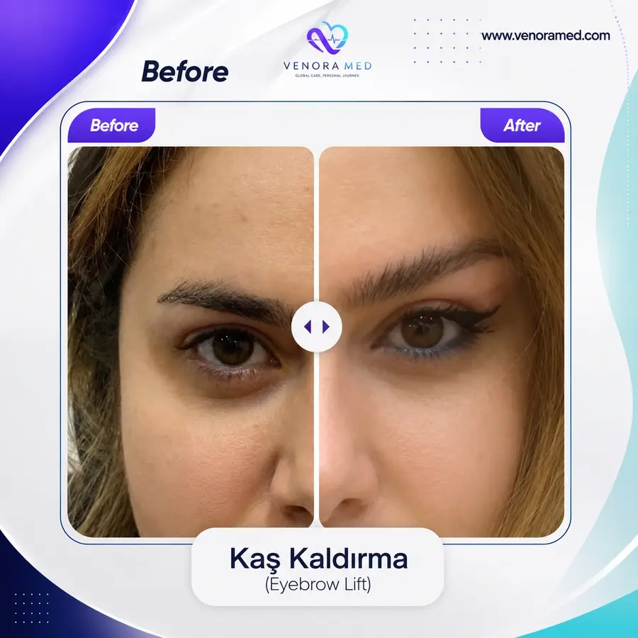 Kaş Kaldırma