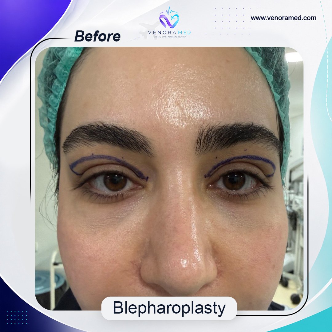 Blefaroplasti before