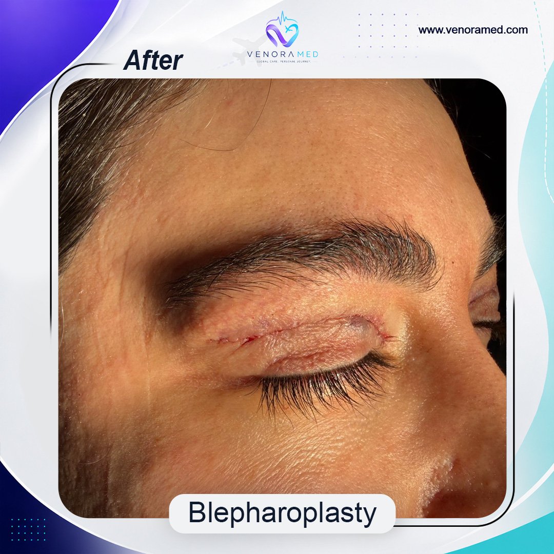 Blefaroplasti after