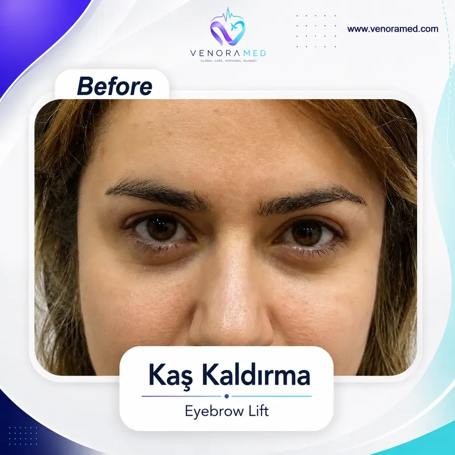Kaş Kaldırma before