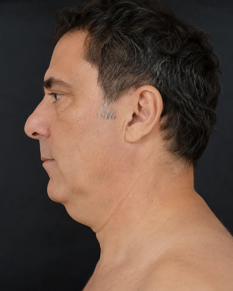 Boyun Germe before