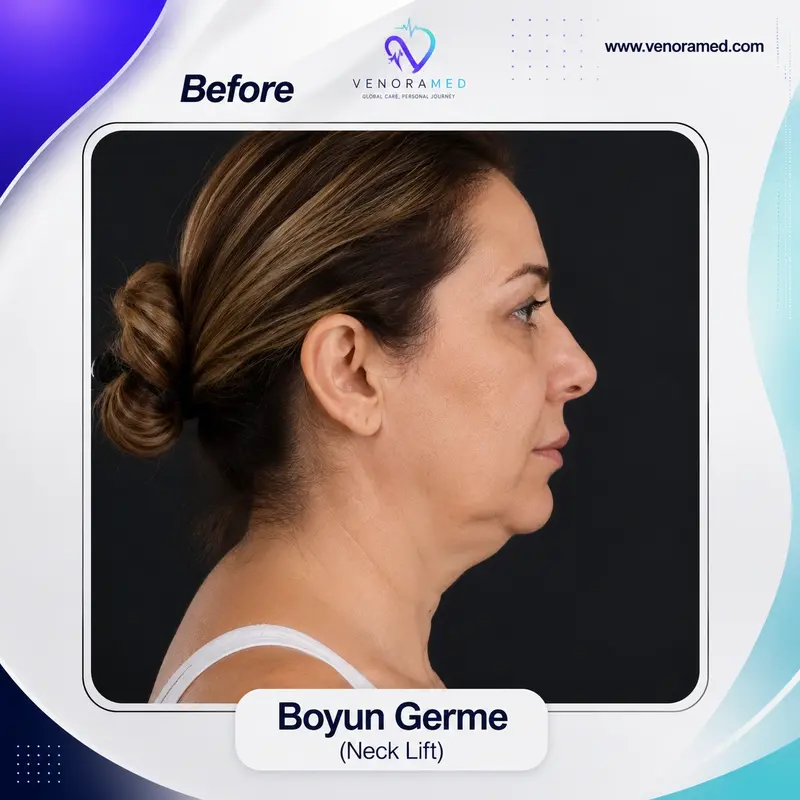 Boyun Germe before