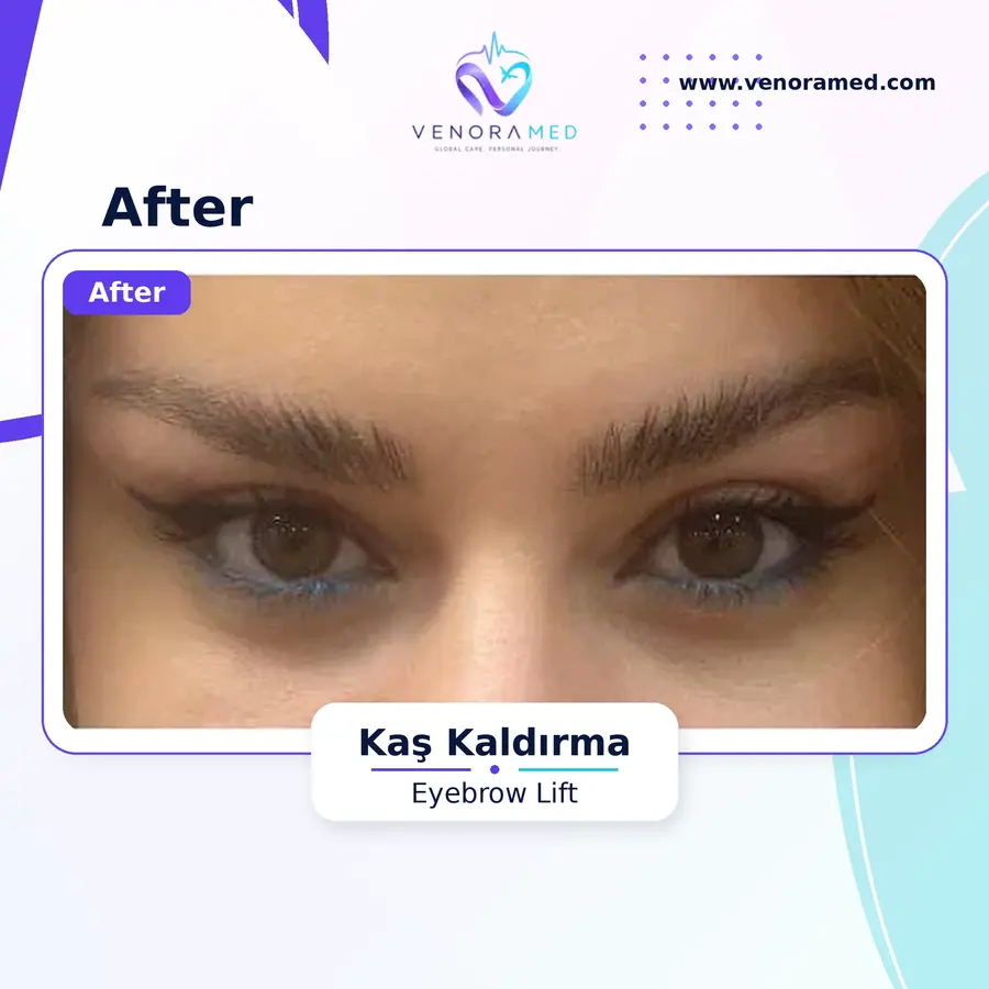 Kaş Kaldırma after