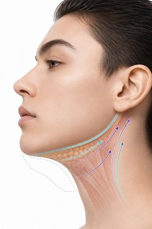 Gıdı Liposuction