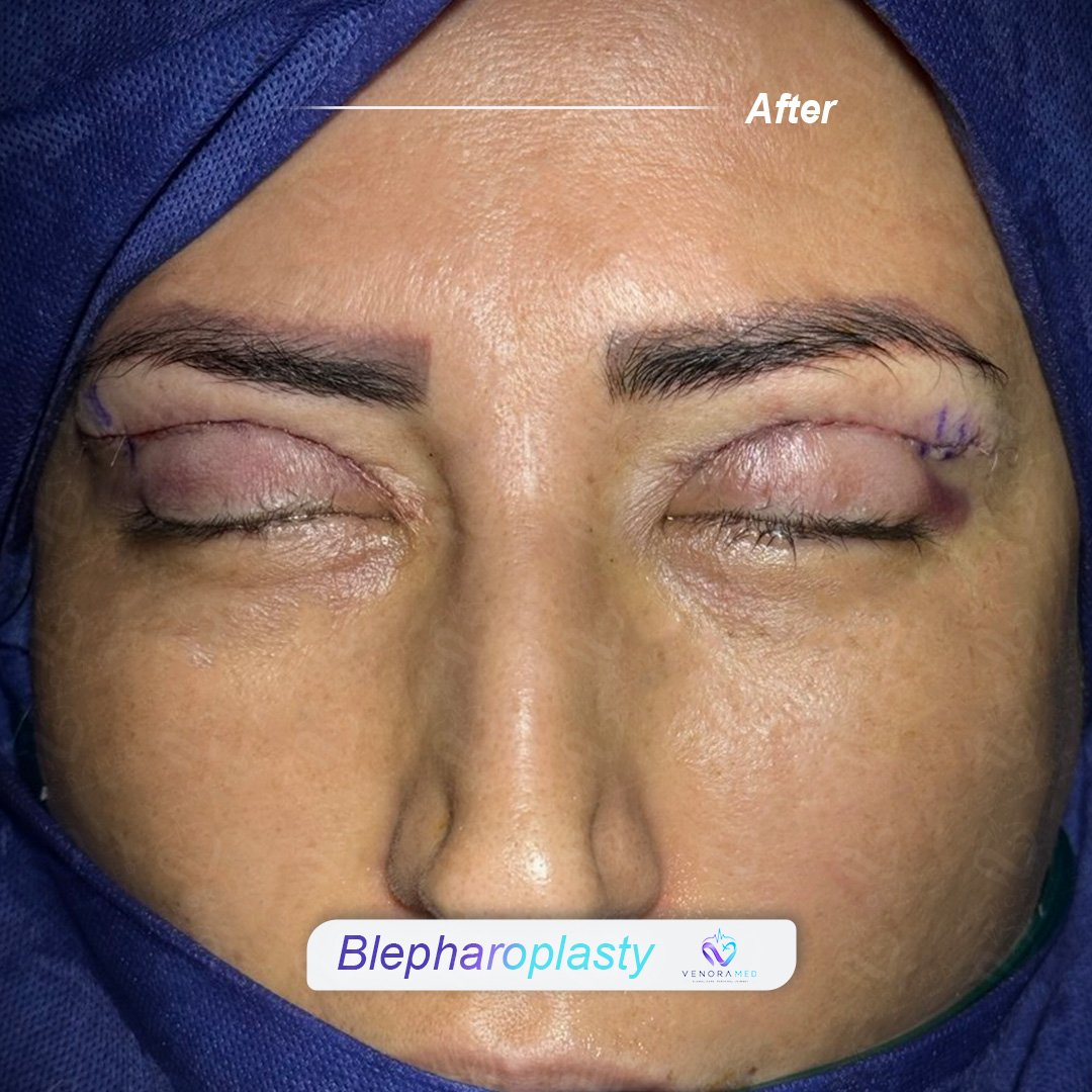 Blefaroplasti Sonrası