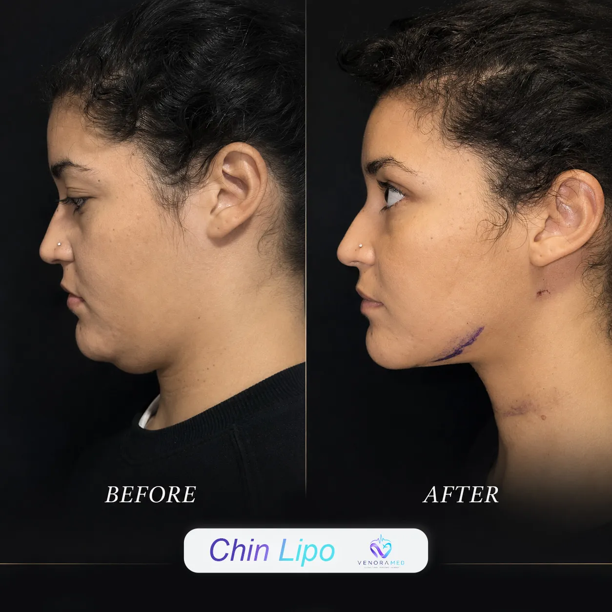 Gıdı Liposuction