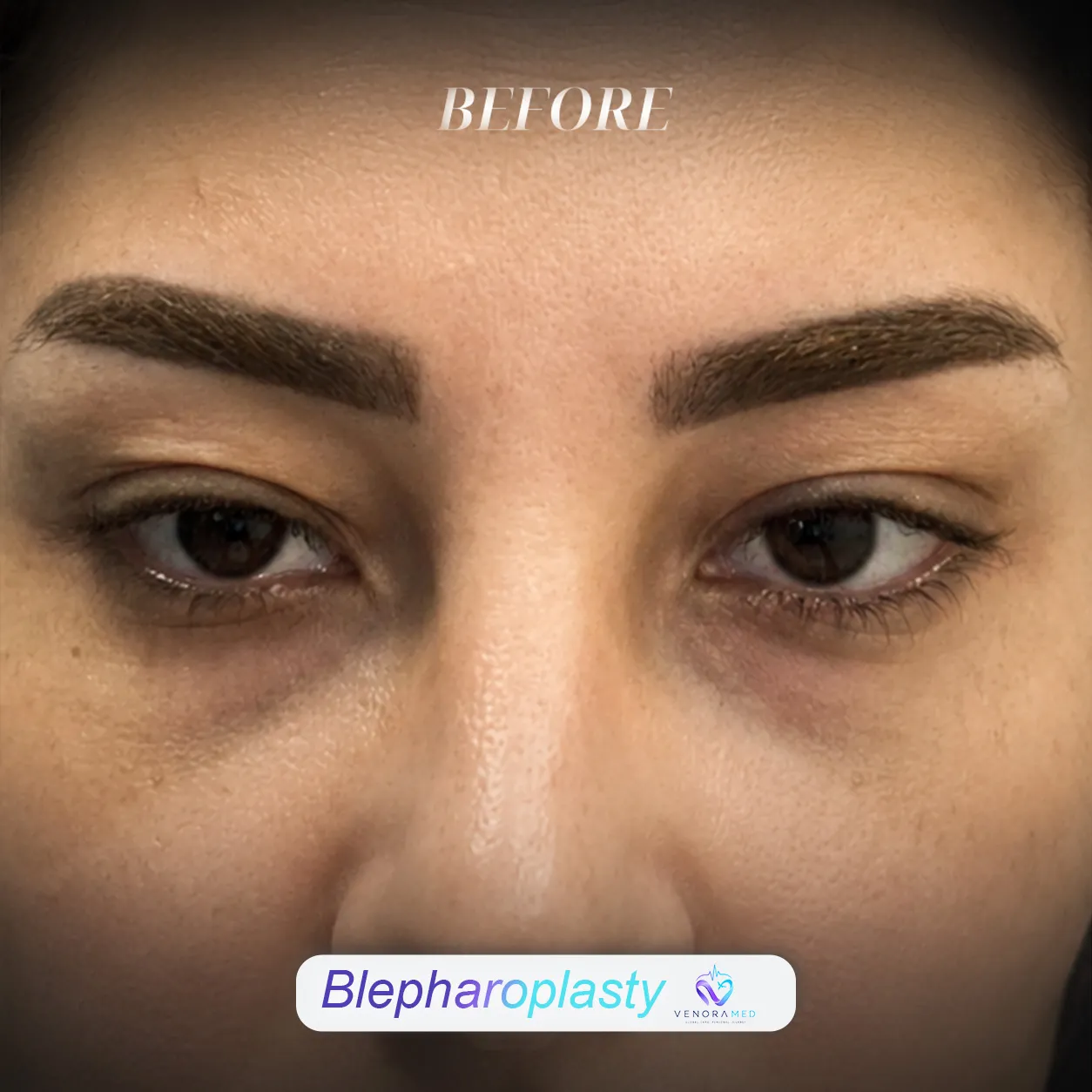 Blefaroplasti Öncesi