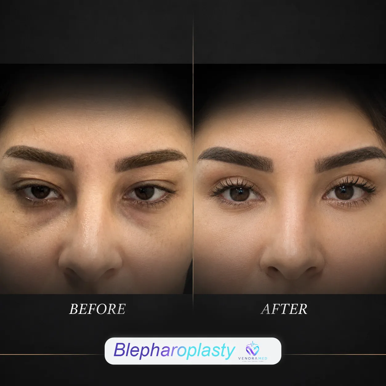 Blefaroplasti