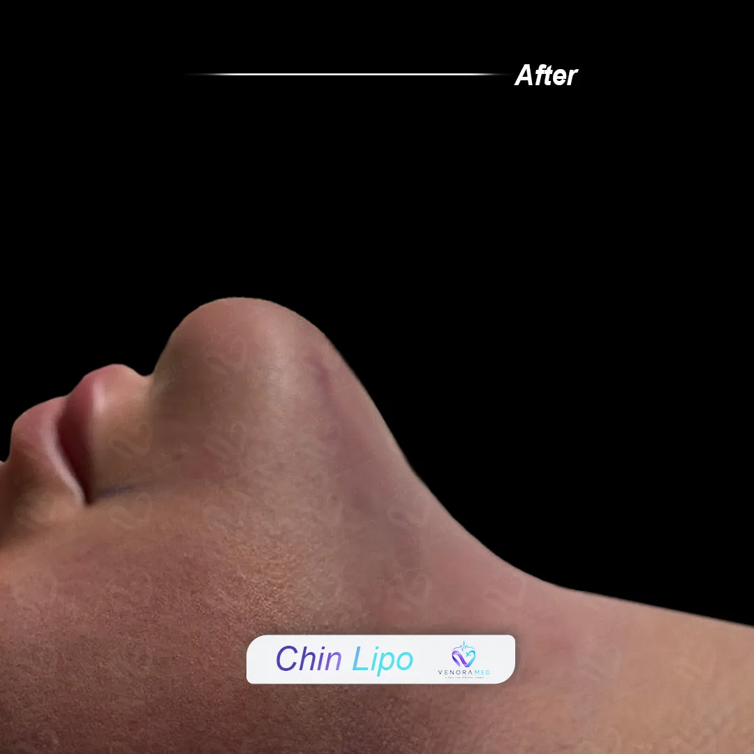 Gıdı Liposuction Sonrası