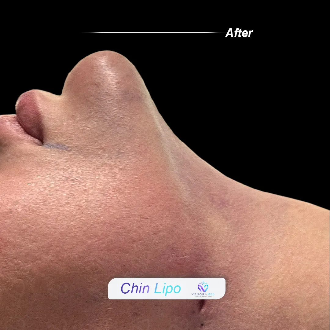 Gıdı Liposuction Sonrası