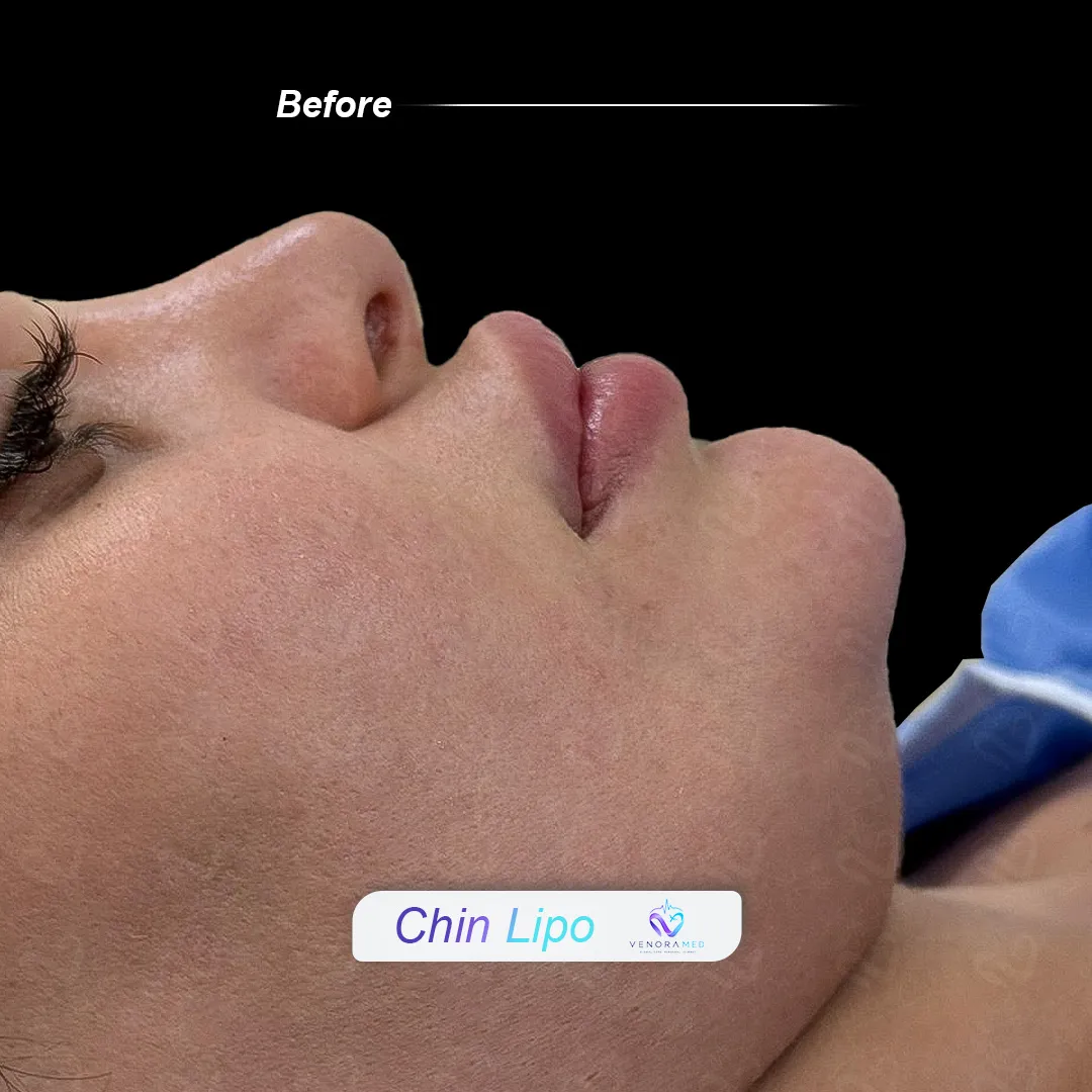 Gıdı Liposuction Öncesi